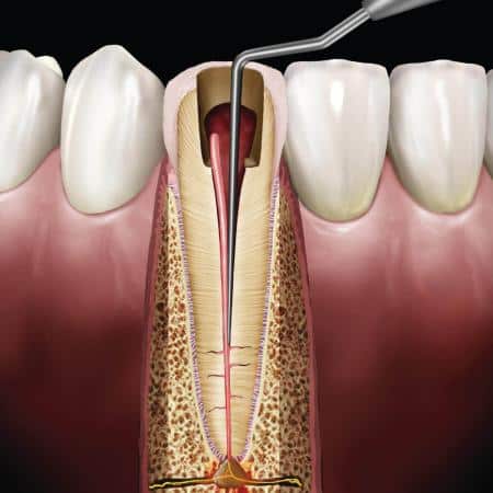 Black Line Endodontic Plugger / Spreader Size GP1 Double End Ea thumbnail 2