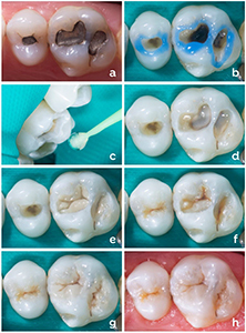 Posterior Restoration Posterior Restoration