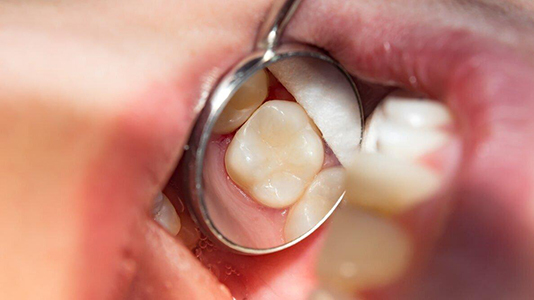 Glass Ionomer
