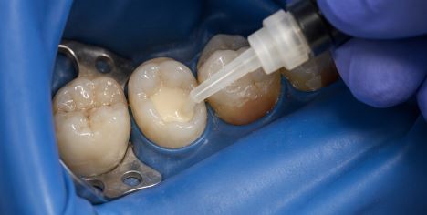 Glass Ionomer 2