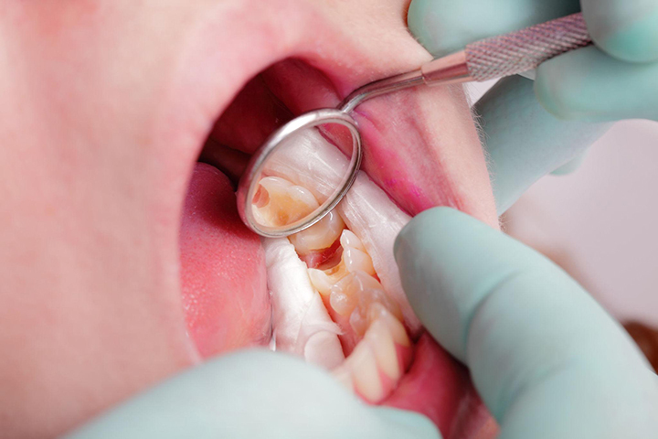 Dental professional examining a posterior tooth during a restorative appointment.