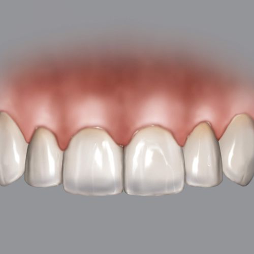 BLPG Replacement Tip Pack of 3 thumbnail 2