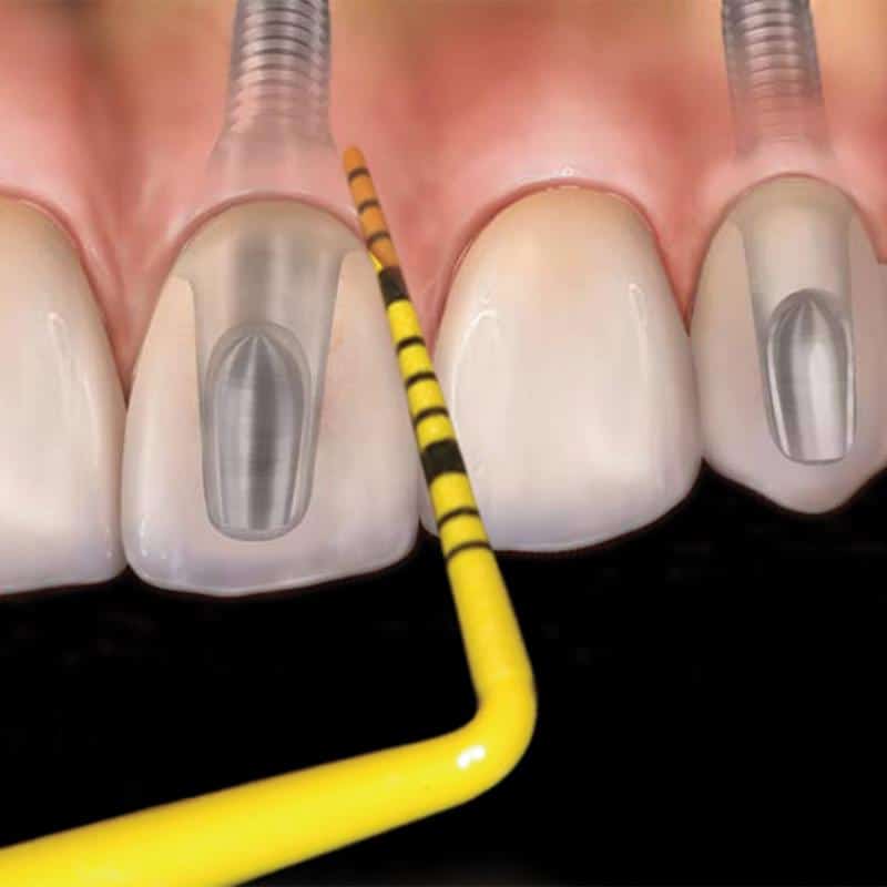 Colorvue Probe Kit 12/Pk, PCVNCKIT12 thumbnail 10